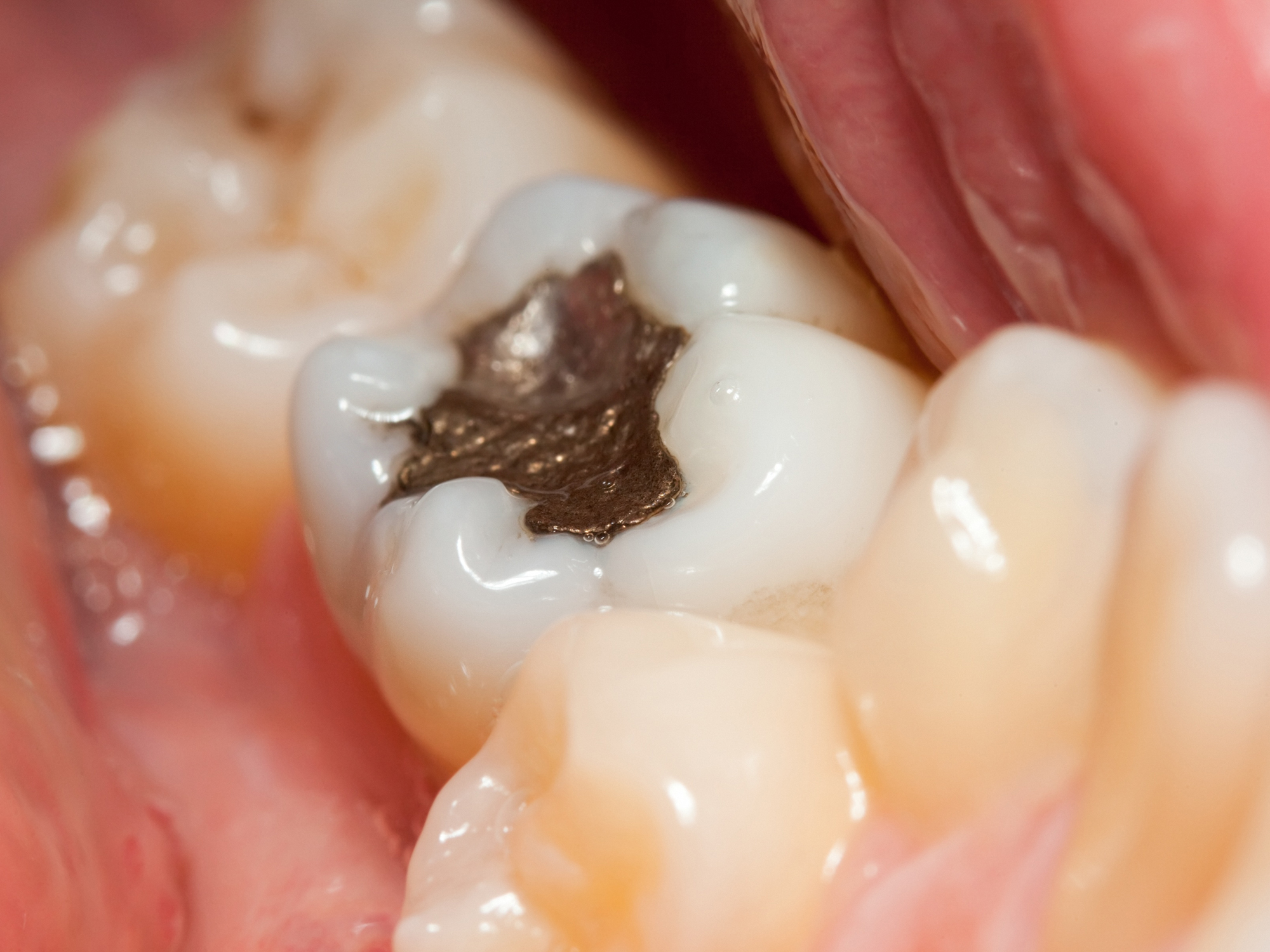 What to do about your toxic mercury fillings