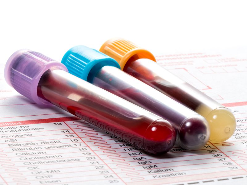 New tests reveal truth about LDL cholesterol - Easy Health Options®