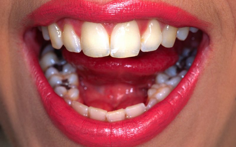 mercury poisoning symptoms dental fillings