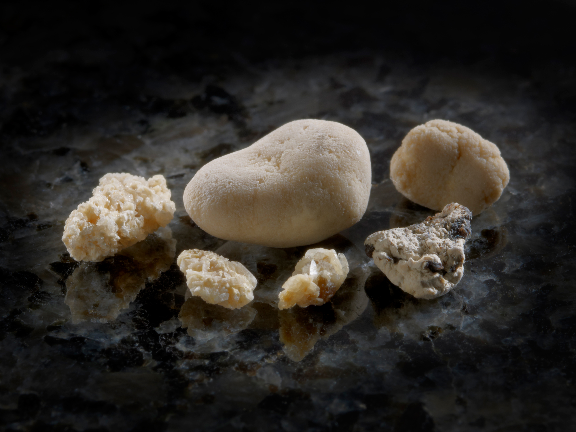 What Are 2 Types Of Kidney Stones