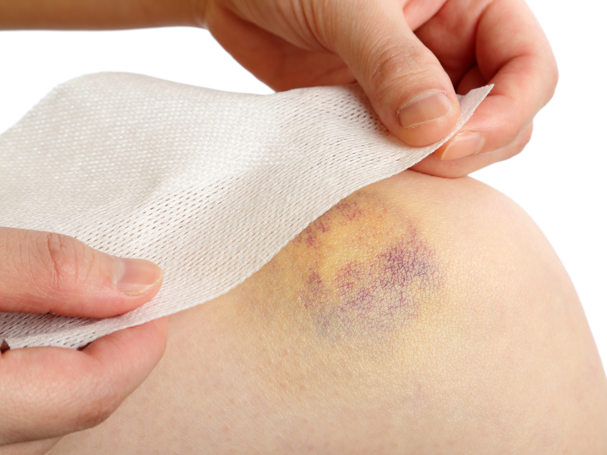 3 supplements that stop unsightly bruising