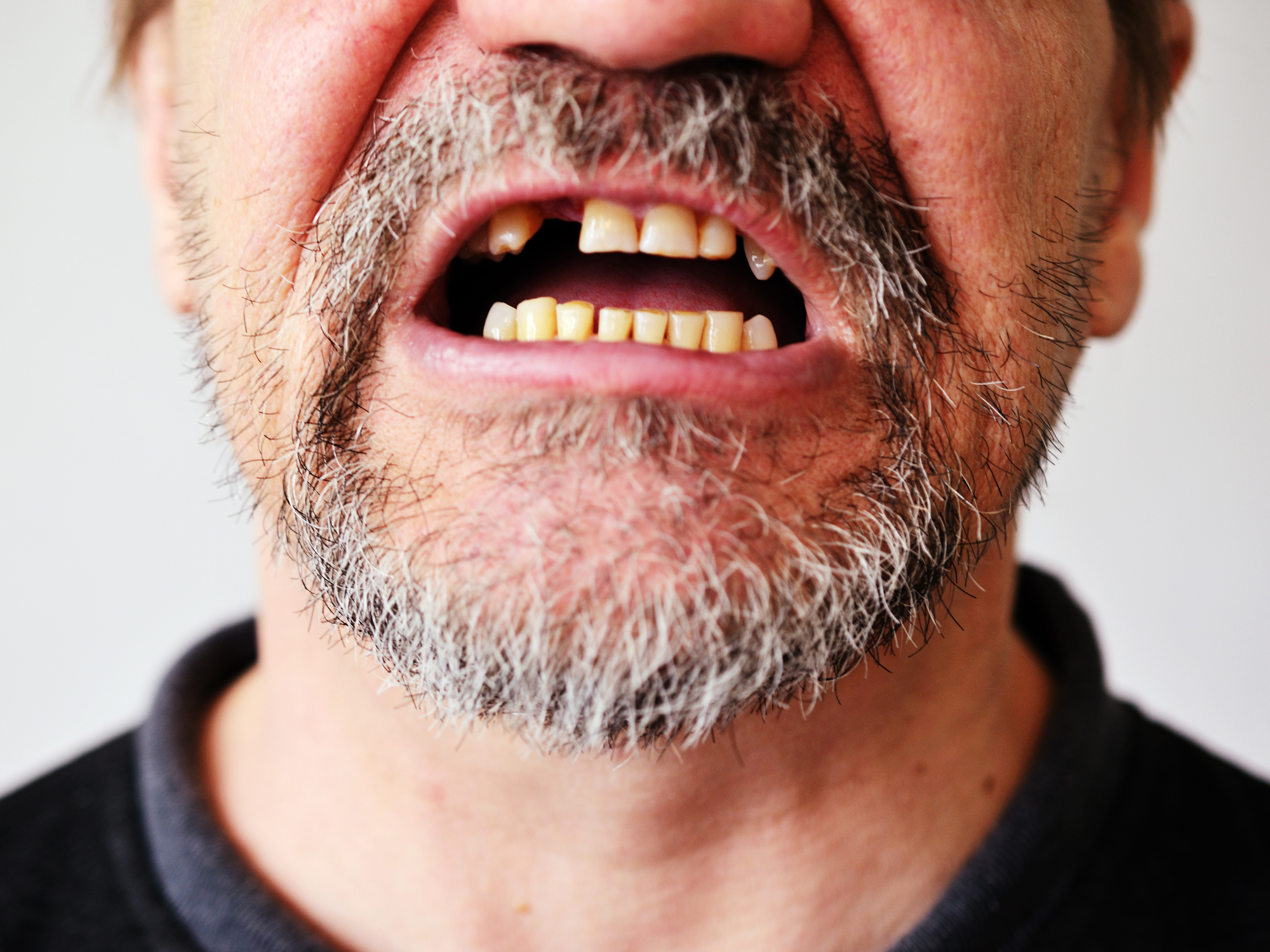 Why this disease sign makes your teeth fall out