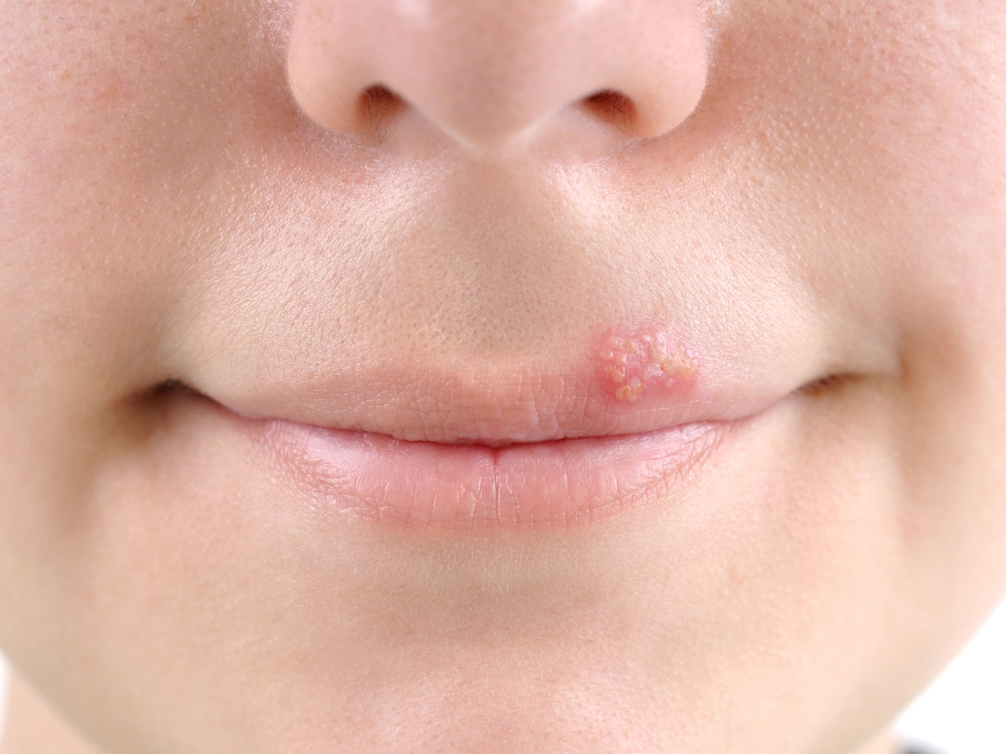 6 natural cures for the common cold sore