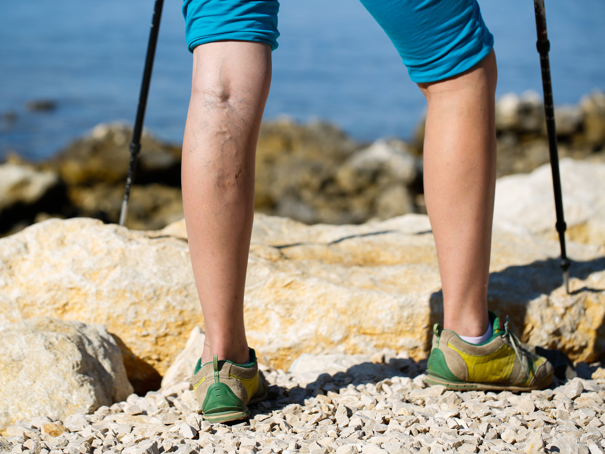 6 ways to make your varicose veins and blood clot risk vanish