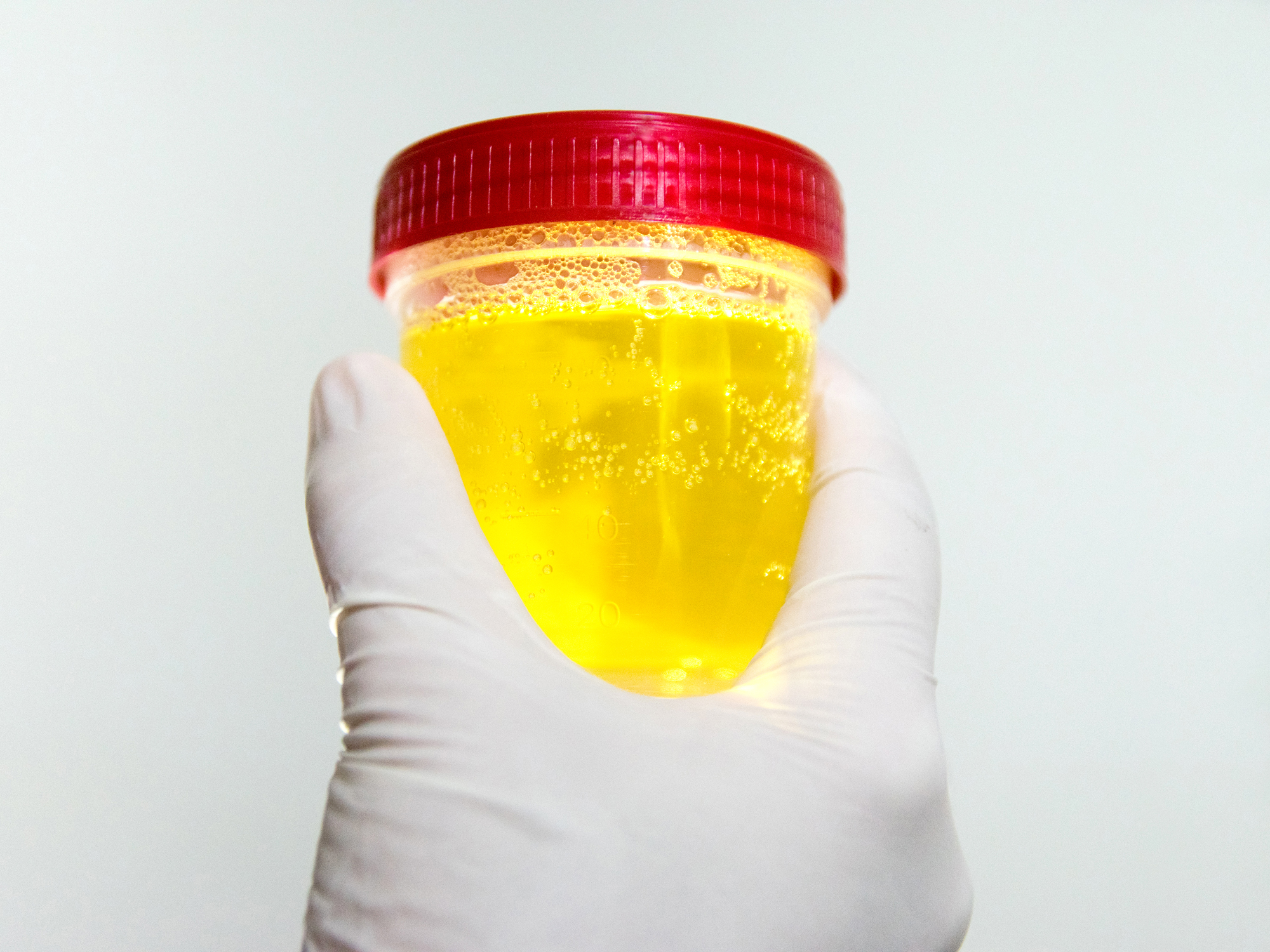 If your urine’s this color, see a doctor