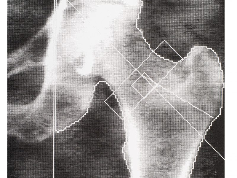 how-to-stop-osteoporosis-before-your-next-bone-density-checkup-easy