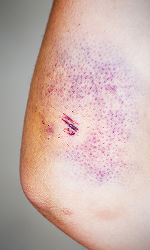 Bruise