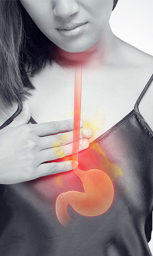 Woman with gastroesophageal reflux disease