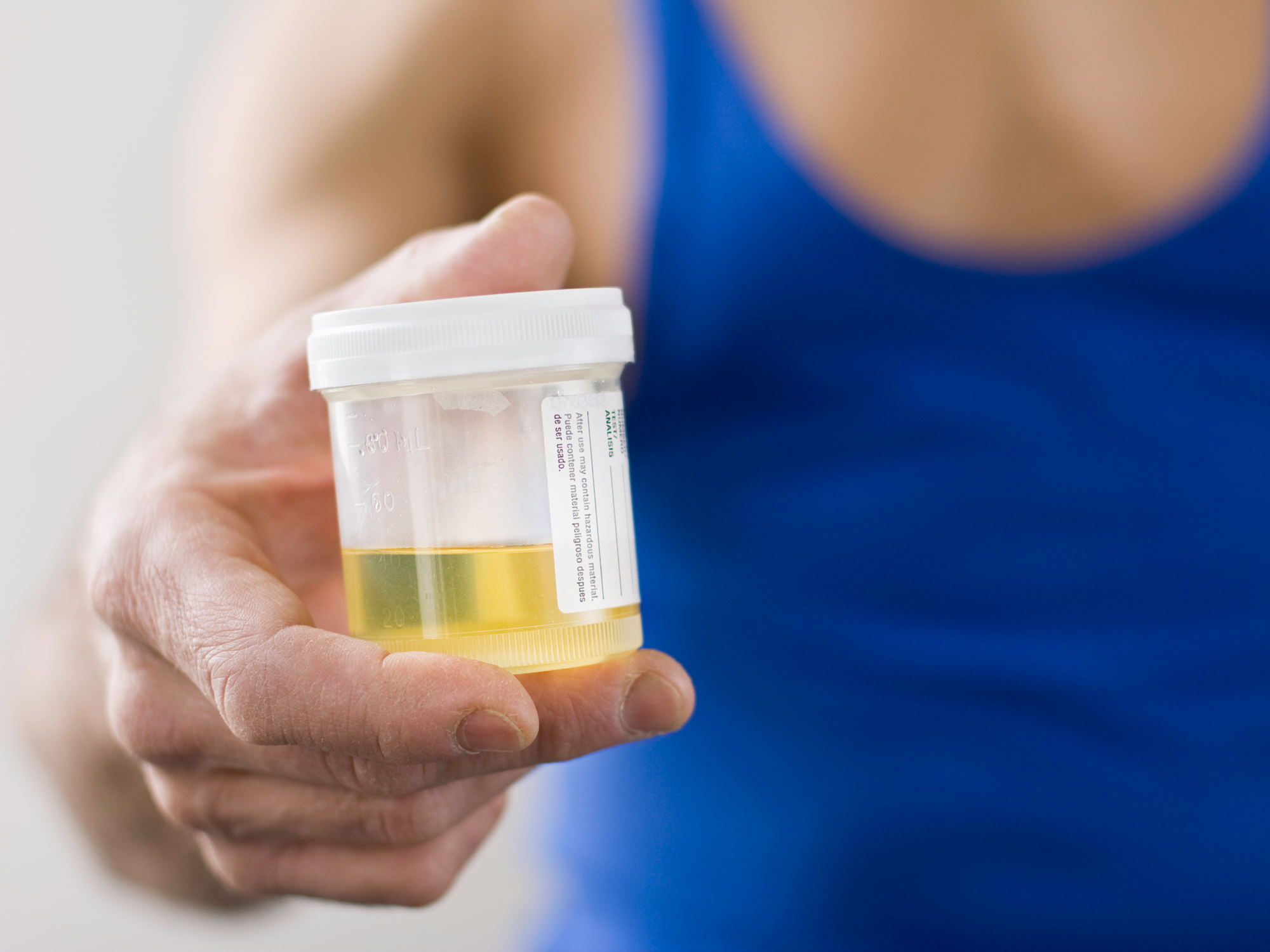 How you could get a superbug from an unnecessary urine test