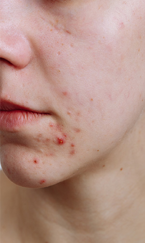 Keto benefits for acne