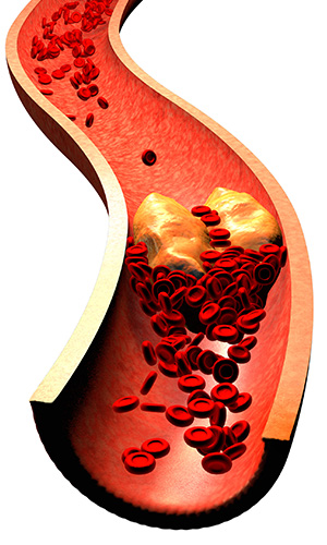 Cholesterol