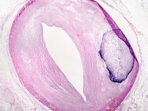 Vascular calcification, a symptom of heart disease