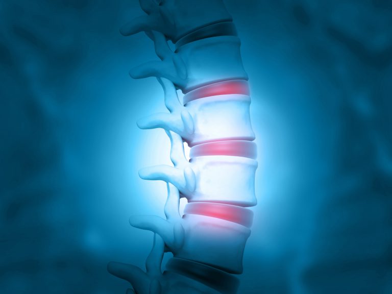 The vitamin your spine needs the most to battle disc degeneration