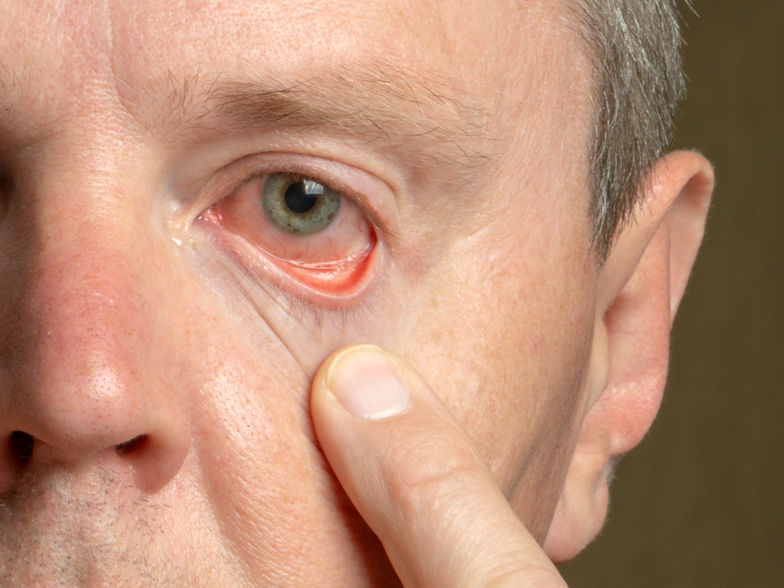 The eye symptom that signals a serious case of COVID-19
