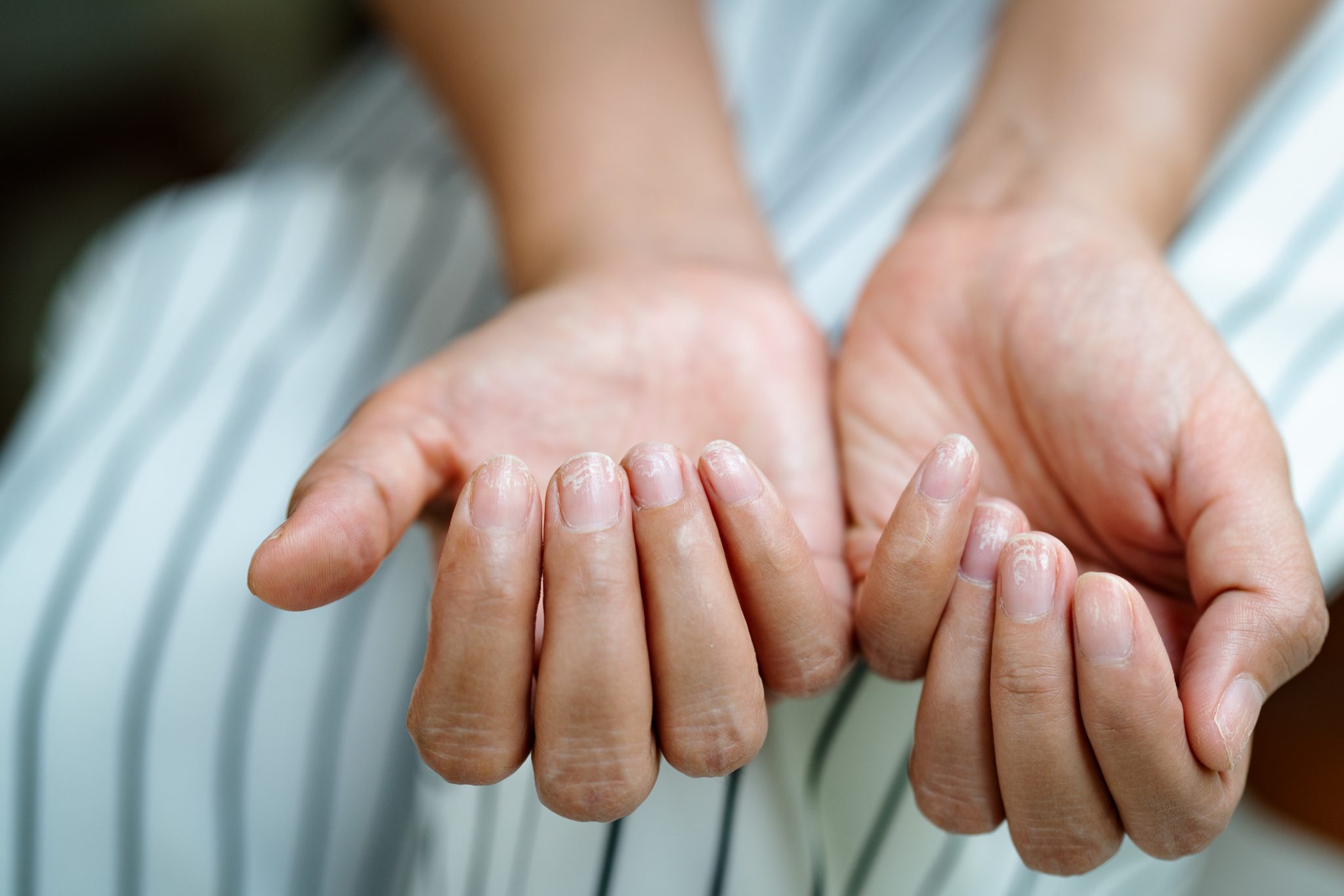 9 Fingernail Signs You Might Be Sick Easy Health Options 