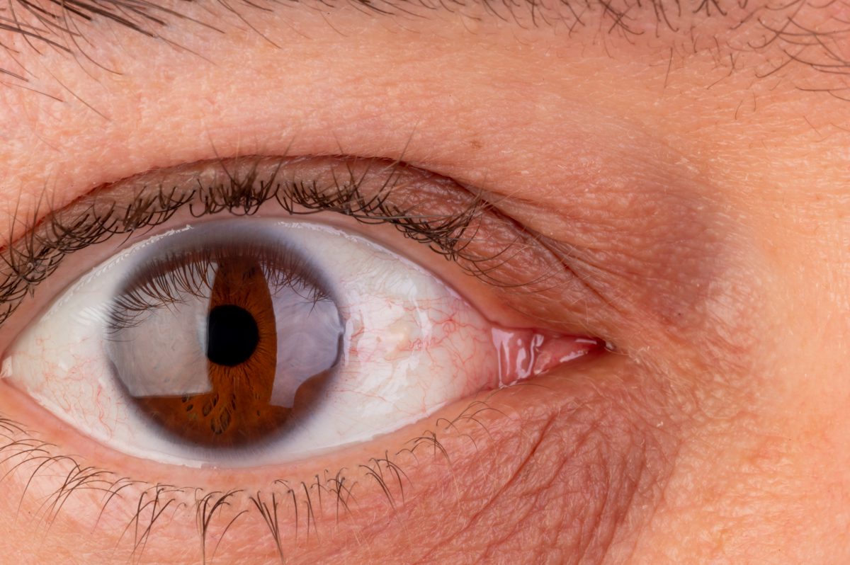 Catching AMD before you start losing vision