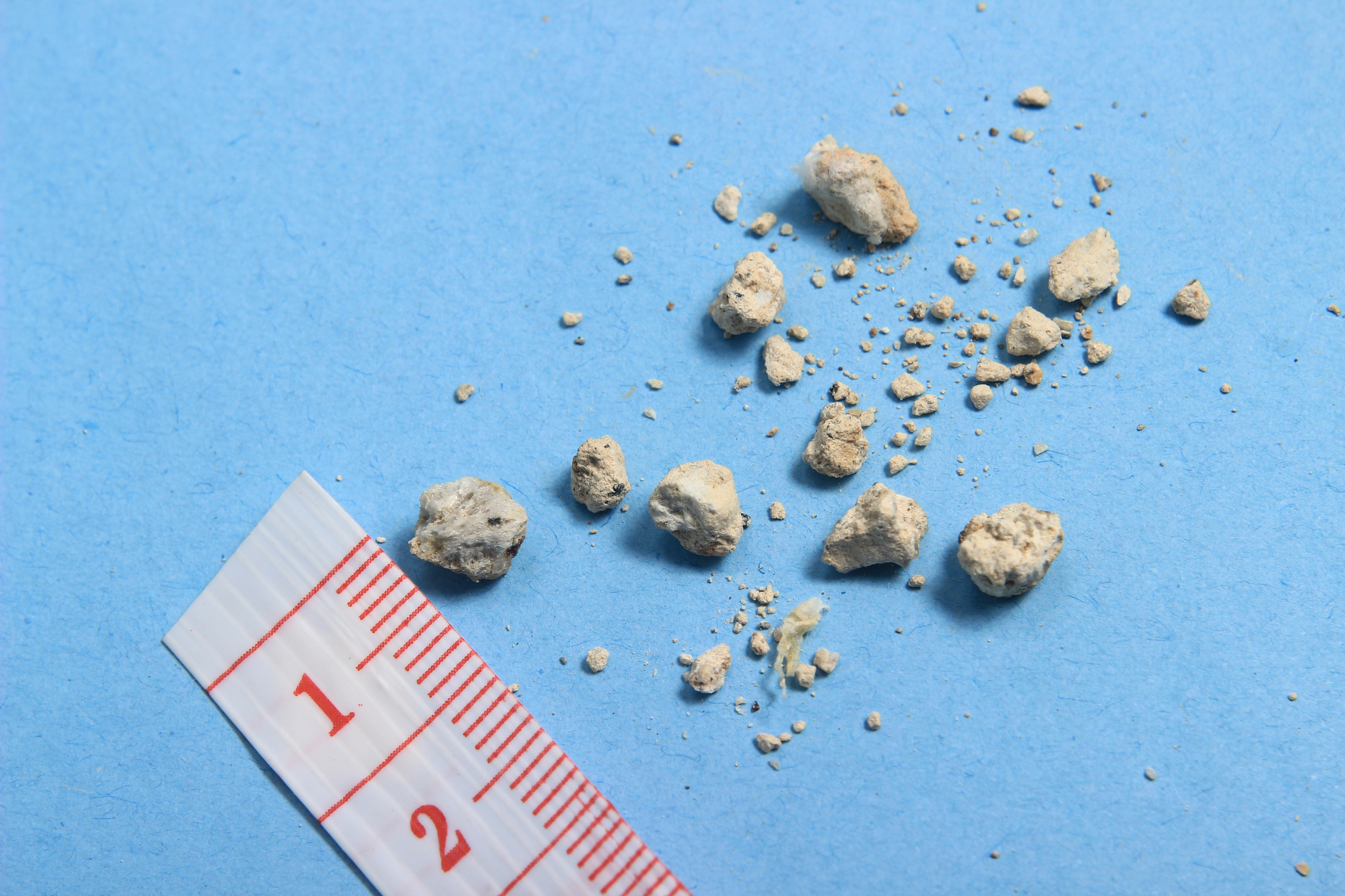 Kidney stones: The sweet tooth connection