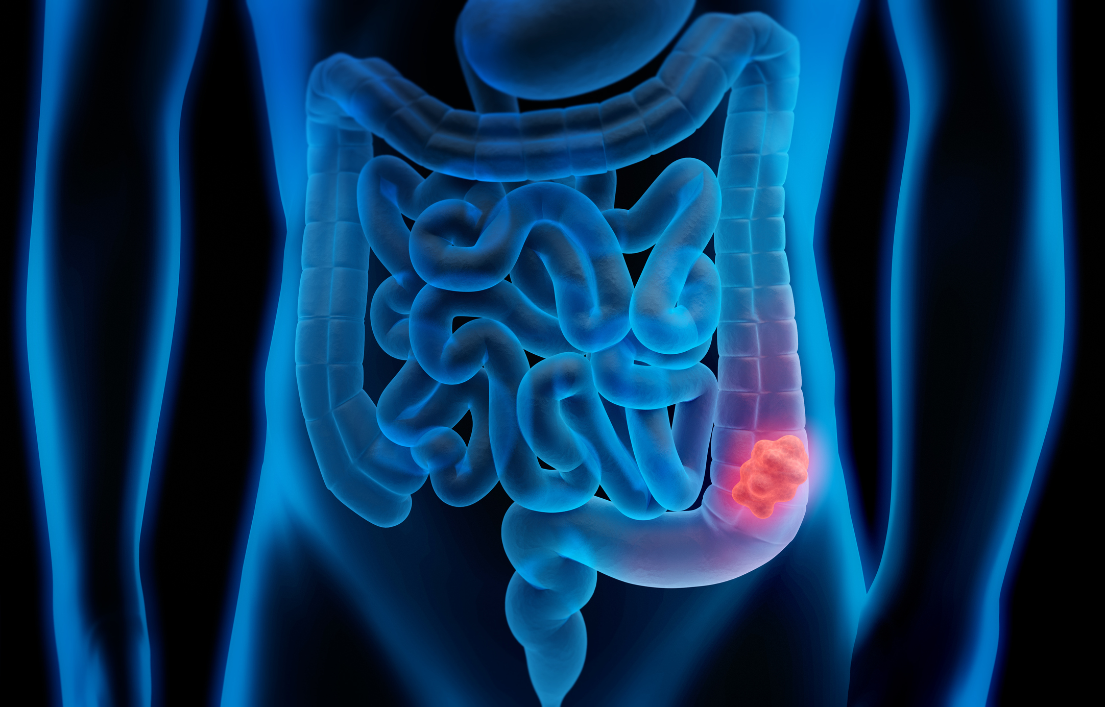 Why the fight against colon cancer might start in your mouth
