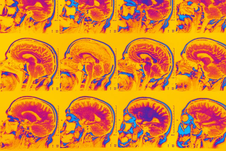 The common condition rapidly aging American’s brains