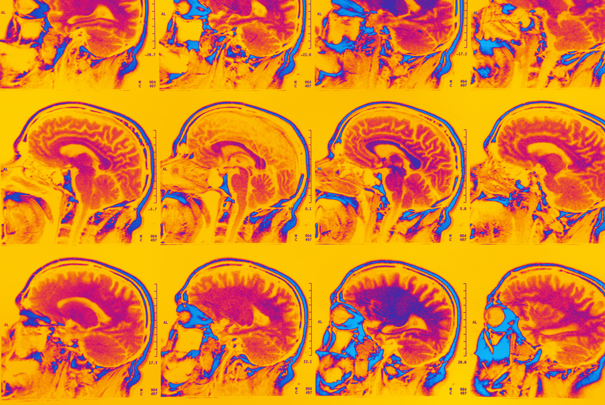 The common condition rapidly aging American’s brains