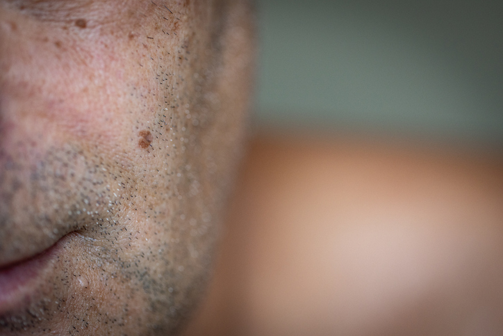 More proof of skin cancer prevention in a vitamin