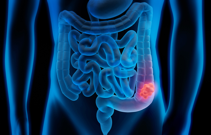 The hidden link between IBD and colorectal cancer